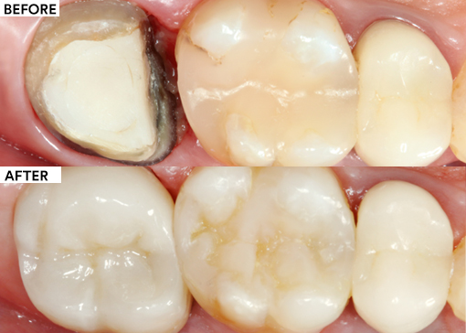 Replacement of a Single Unit Molar Crown Featured Image