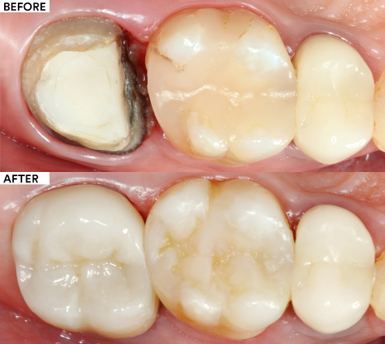 Replacement of a Single Unit Molar Crown Hero