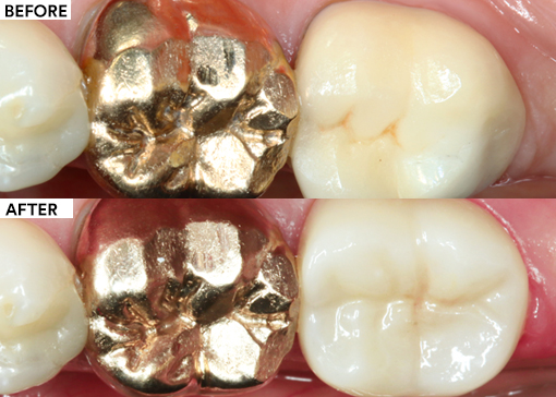 All-ceramic replacement featured image