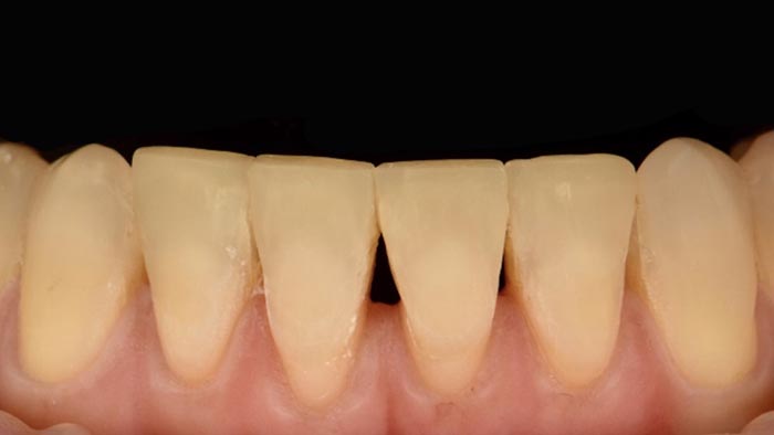 Meeting the challenges related to worn anterior teeth with the single-shade technique