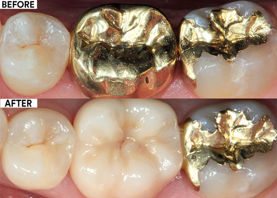 Lower molar crown replacement