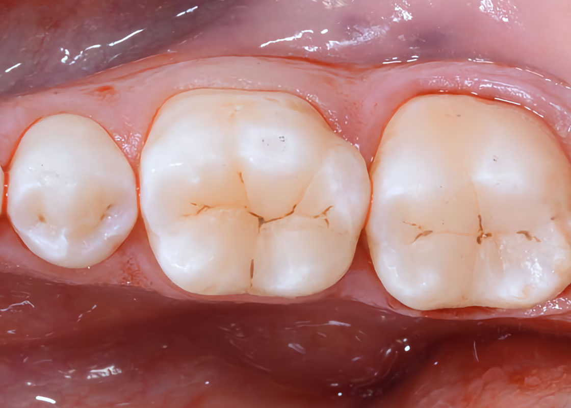 Essential lines: Direct posterior restorations simplified