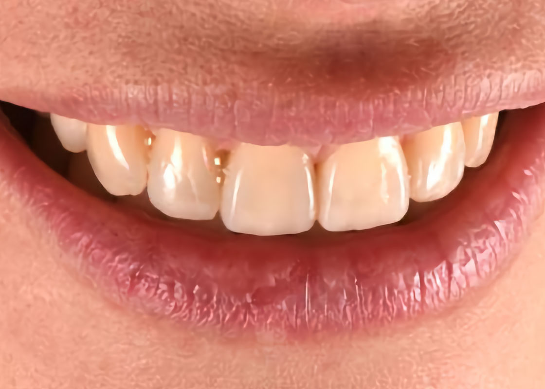 Multi-layered-restorations-for-female-patient-with-localized-anterior-tooth-wear