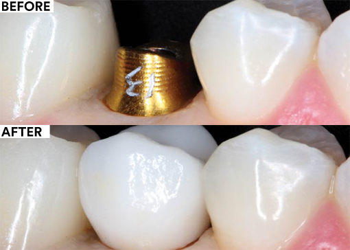 RMGI dental cement for implant restoration - before and after