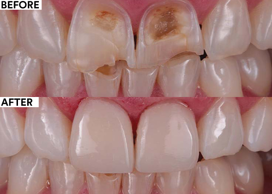 Solving esthetic issues in the anterior region with composite before and after