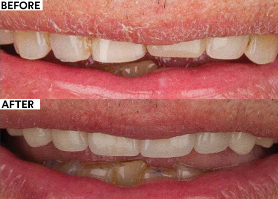 Replacement of Insufficient Restorations to Improve Esthetic Appearance - Before and After