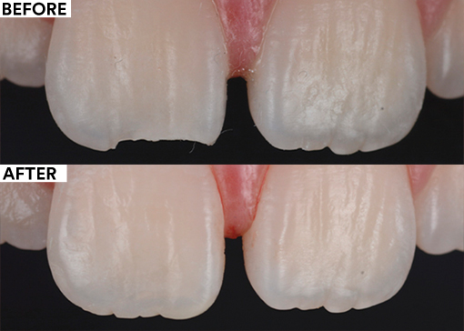 Fixing margin enamel chipping - before and after