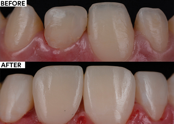 Stabilizing complex cases with single shade composites before and after