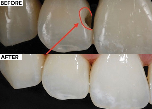 Bioclear Matrix before and after