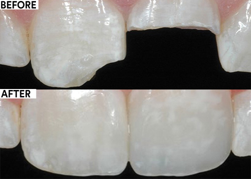 Esthetic restoration of maxillary central incisors before and after