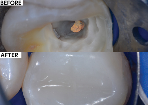 Over-molding following root canal treatment before and after