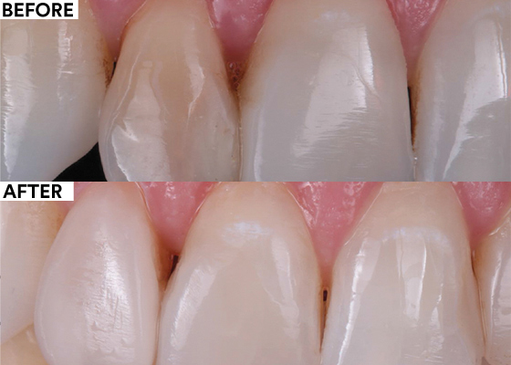 Non-invasive restorative treatment of a discolored lateral incisor before and after