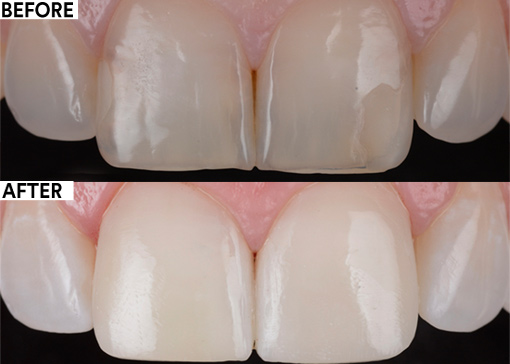 Reinforcing esthetics and structure by additive dentistry