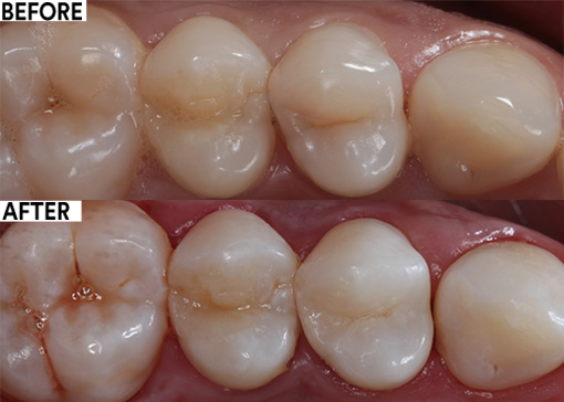 Hidden caries on upper first pre-molar