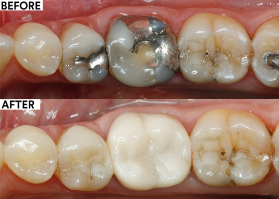 Self-adhesive cementation of a zirconia crown