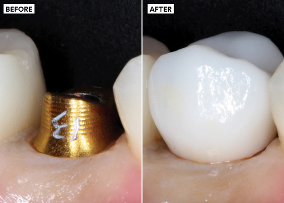 Cemented implant restoration
