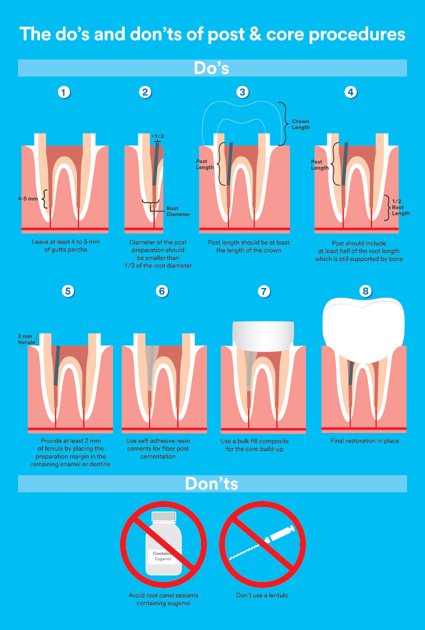 Post and core infographic