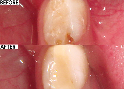 Glass ionomer restorative in the primary dentition