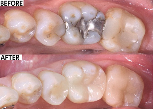 Selective-etch adhesive cementation before and after