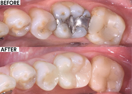 Selective-etch adhesive cementation before and after