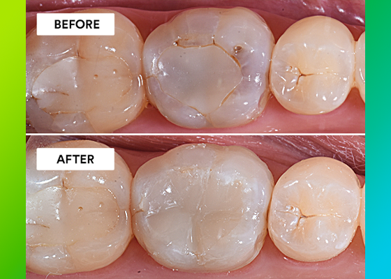 before and after