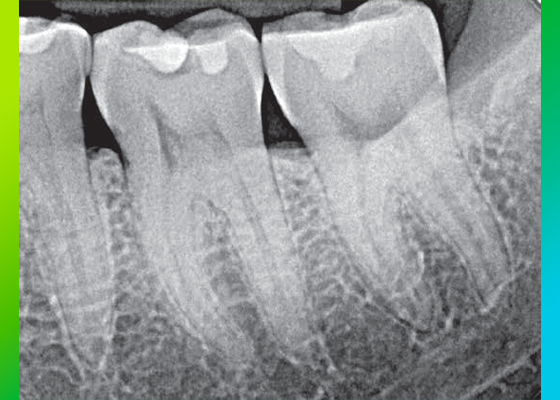 Radiolucent areas under resin composite restorations as a result of adhesive pooling