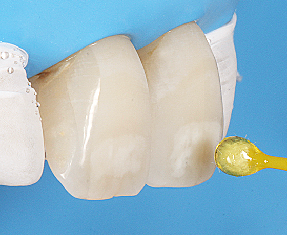 Close up of tooth with 3M filtek bulk fill restorative applied