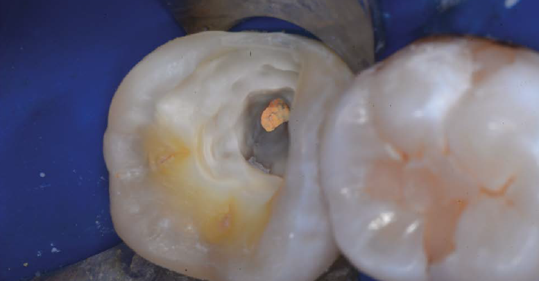 Tooths shows that endodontic therapy is complete and caries removal is confirmed