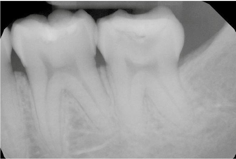 Pre and post-operative radiographs of the completed endo-restorative procedure are shown (this and the next image)
