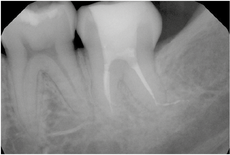 Pre and post-operative radiographs of the completed endo-restorative procedure are shown (this and the image before)