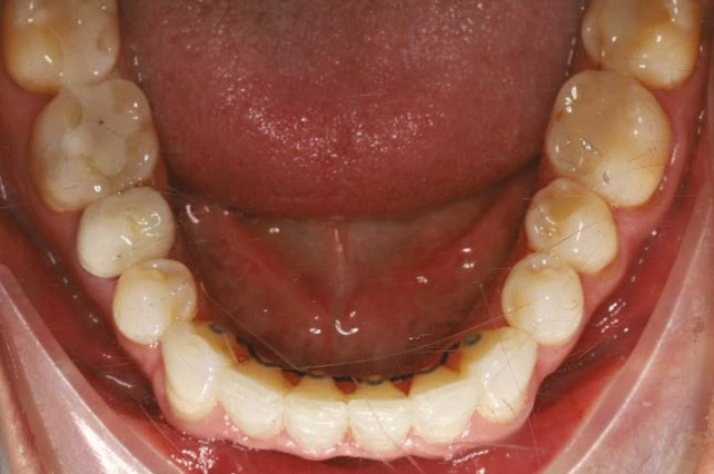 Post-treatment occlusal after lingual fixed retainer reapplied