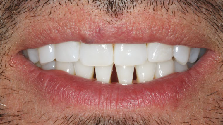 Pre-treatment smile frontal