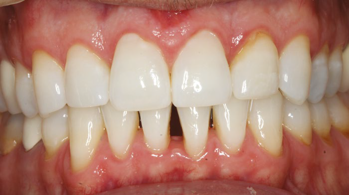 Pretreatment intra oral retracted photo.