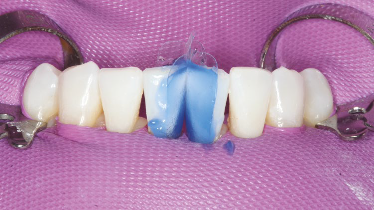 Anterior Bioclear matrices inserted and application of Scotchbond™ Universal Etchant