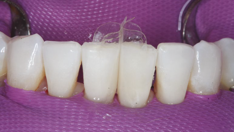 Filtek Supreme Flowable injected followed by warmed Filtek Supreme XTE (B1) sculptable composite resin