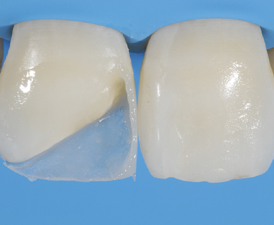 Mesial wall after light curing and matrix removal.