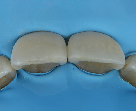 Incisal view of the restoration.