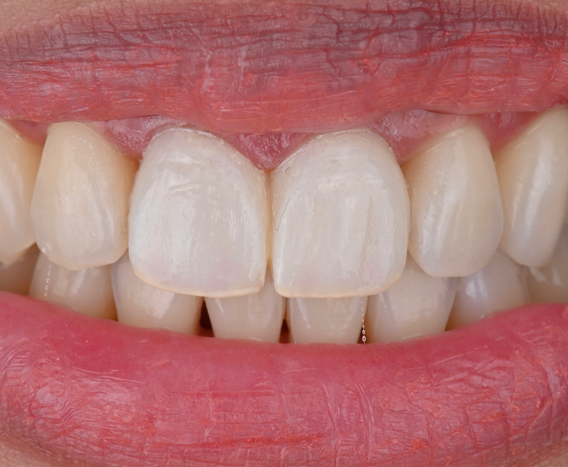 Temporary crowns made with 3M™ Protemp™ 4 Temporization Material in place