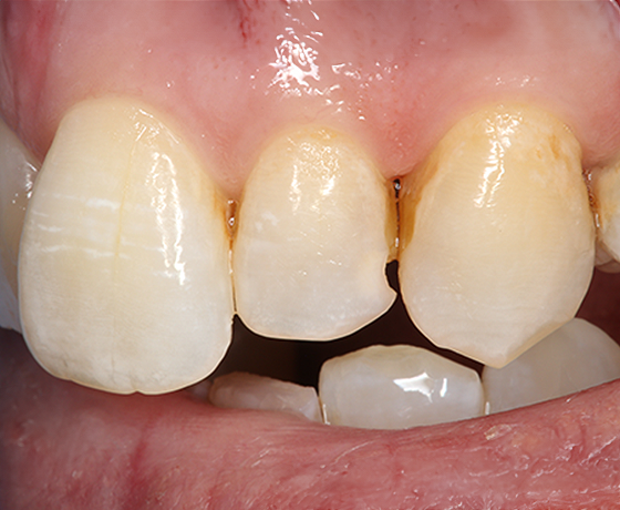 Preoperative.  Monomer degradation, broken and aged restorations