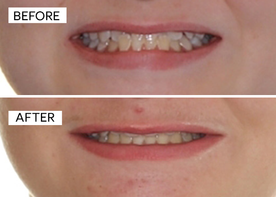 Before and after showing straight teeth