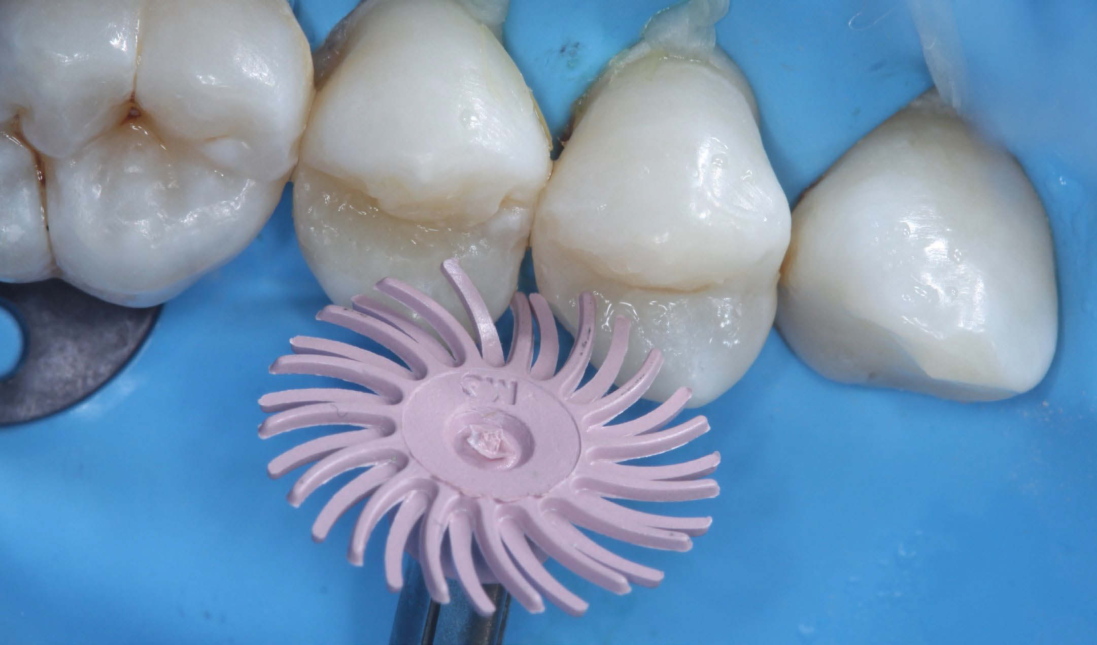 Teeth close up, polishing the fixed tooth with a spiral