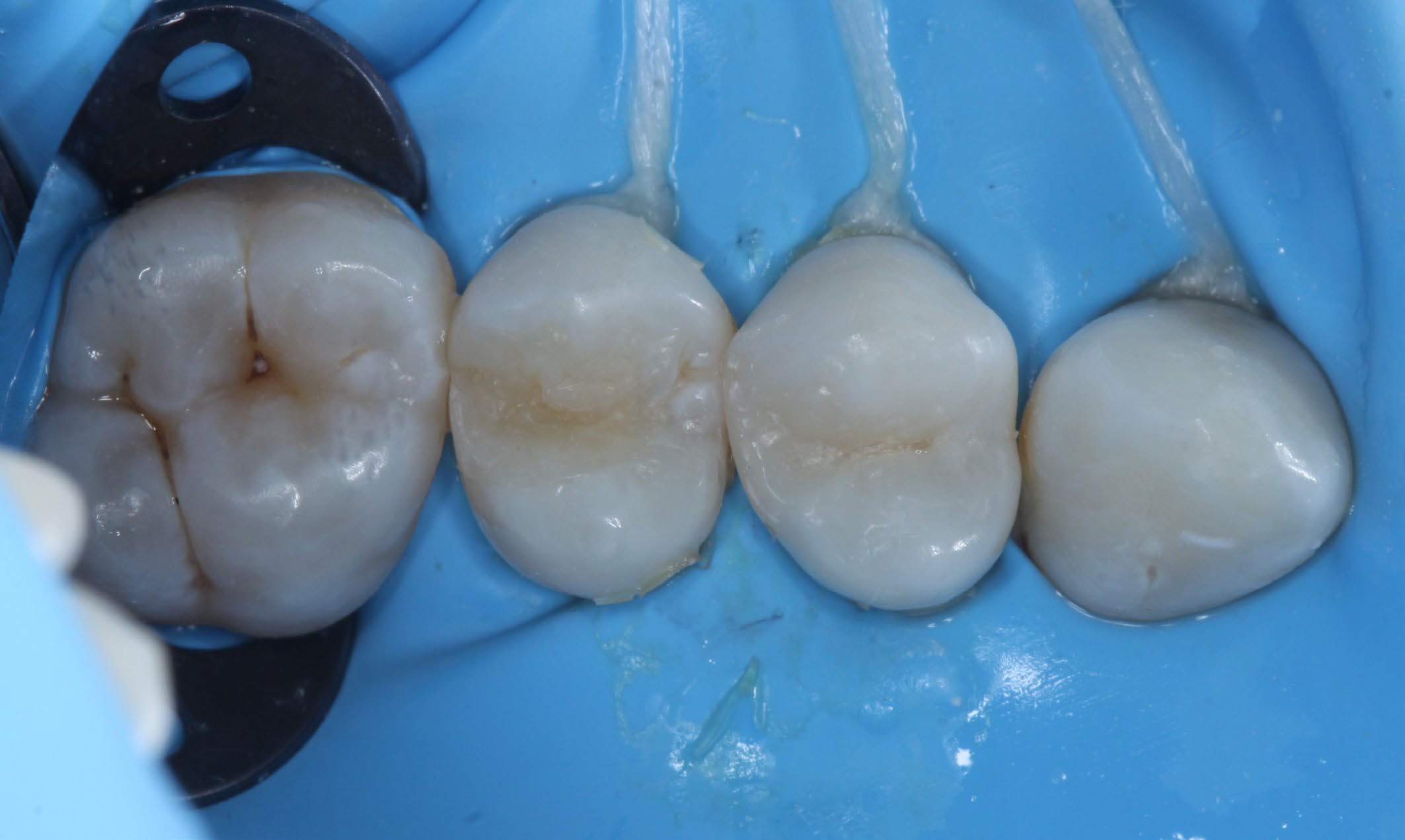 Teeth closeup with result