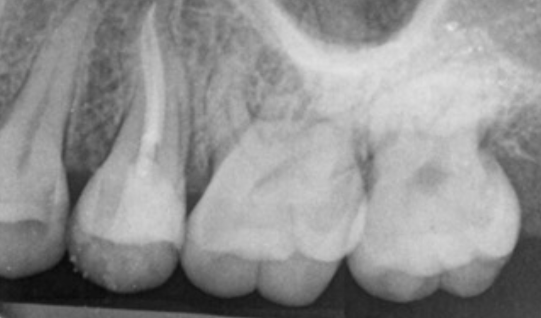 Teeth X-ray