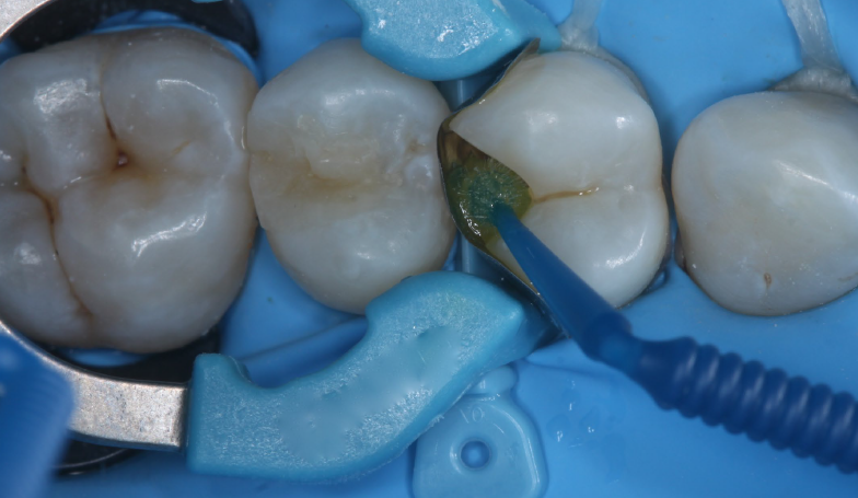 Closeup of teeth being fixed with tools