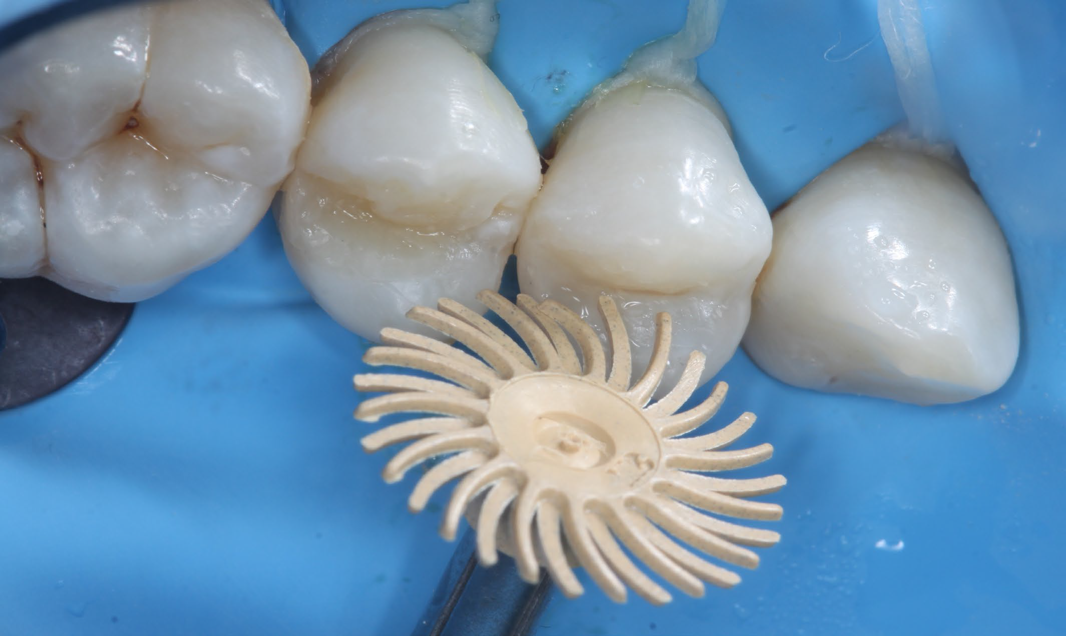 Teeth close up, polishing the fixed tooth with a spiral