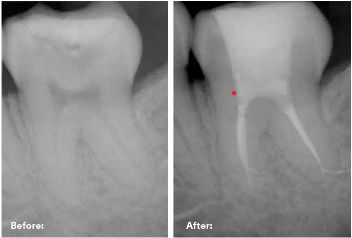 xray scan of the tooth before and after