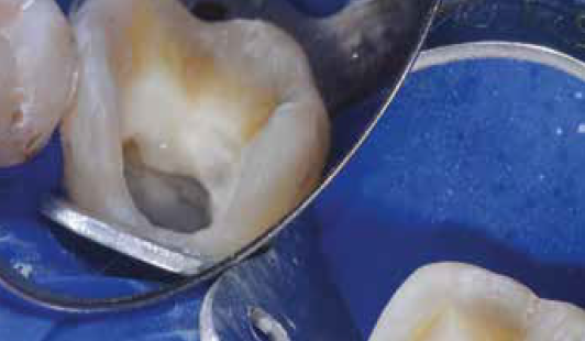 close up tooth with hie and metal barrier