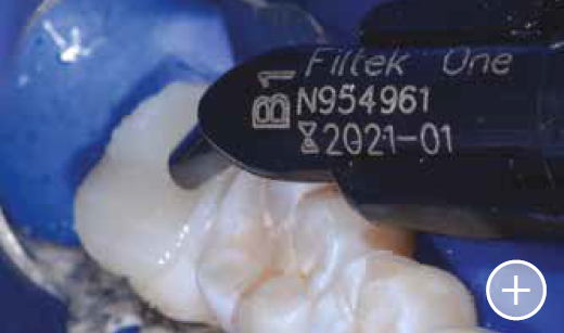 close up teeth with Fitek one