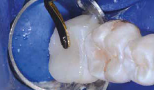 close up teeth with material being filled in