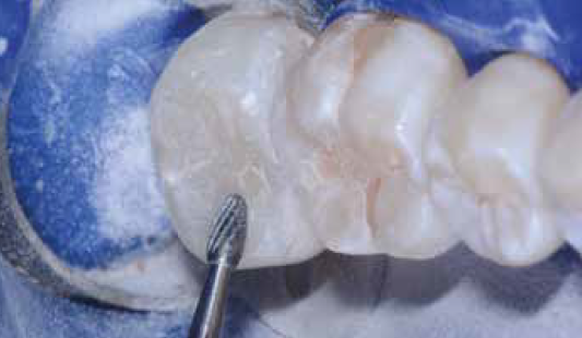 close up teeth being formed